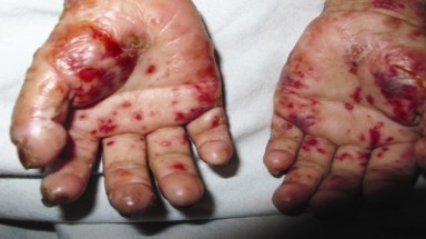  Bé gái mắc bệnh "ma cà rồng"