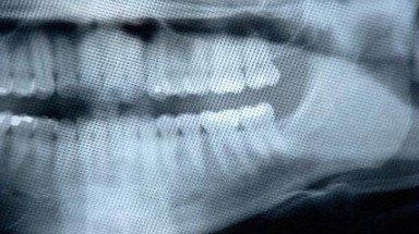 Chụp X-quang nha khoa gây ung thư não? 