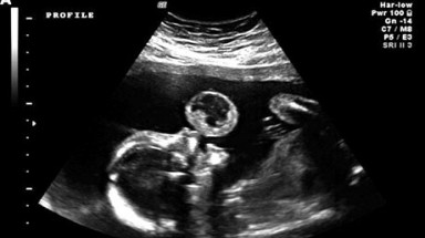 Lần đầu tiên trên thế giới mổ lấy u trong bào thai