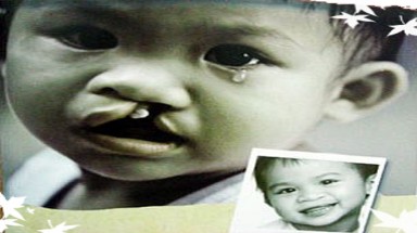 Phẫu thuật chẻ vòm hầu cho trẻ khi nào?