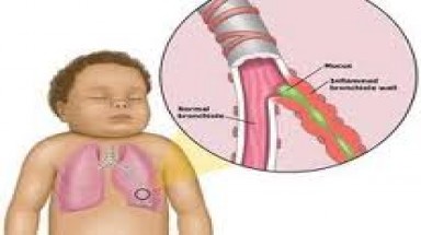 Viêm tiểu phế quản cấp có nguy hiểm?