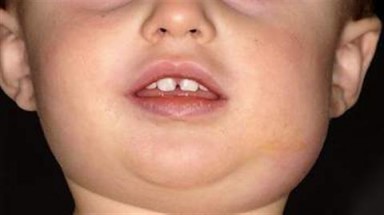 Bị quai bị, cẩn thận dẫn đến viêm não?