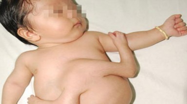 Bé mới sinh có 4 cánh tay