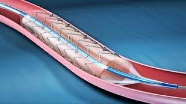 Sau đặt stent có cần uống thuốc?