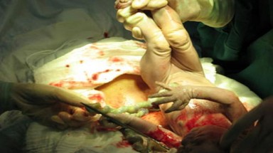 Nhiễm khuẩn nặng do bác sĩ quên gạc