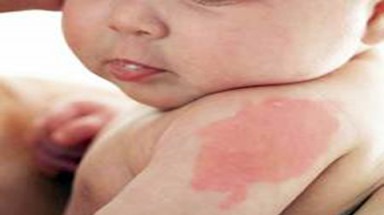 Chấm tròn tụ máu có gây biến chứng?