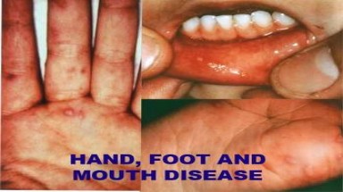 Khẩn cấp phòng chống bệnh tay chân miệng