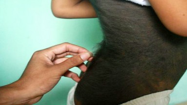 Bé trai mọc lông như ”người sói”