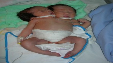  Bé gái có hai đầu ở Sóc Trăng 