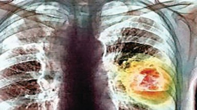 Ra đời thuốc chống ung thư phổi