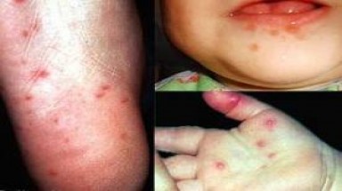 Phòng chống bệnh tay chân miệng khi thời tiết giao mùa