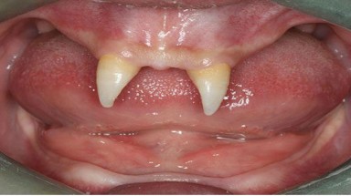 Cậu bé mang hàm răng "ma cà rồng"