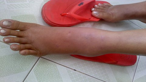 Chân[-]bệnh[-]nhân[-]bị[-]sưng[-]to[-]do[-]có[-]khối[-]giun[-]gây[-]áp[-]xe[-]di[-]chuyển.