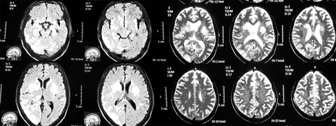 Hình[-]ảnh[-]nấm[-]não[-]trên[-]phim[-]MRI.